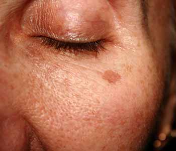 Brown Spots Treatment, Wellesley, MA