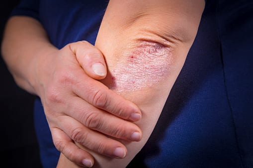 Psoriasis Treatment in Mountain View