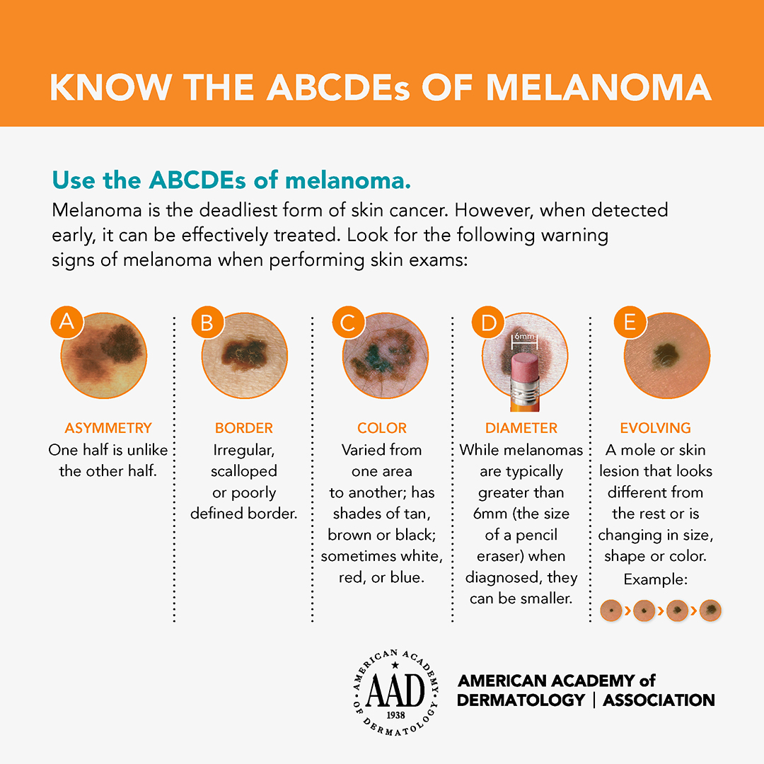 ABCDEs of Melanoma