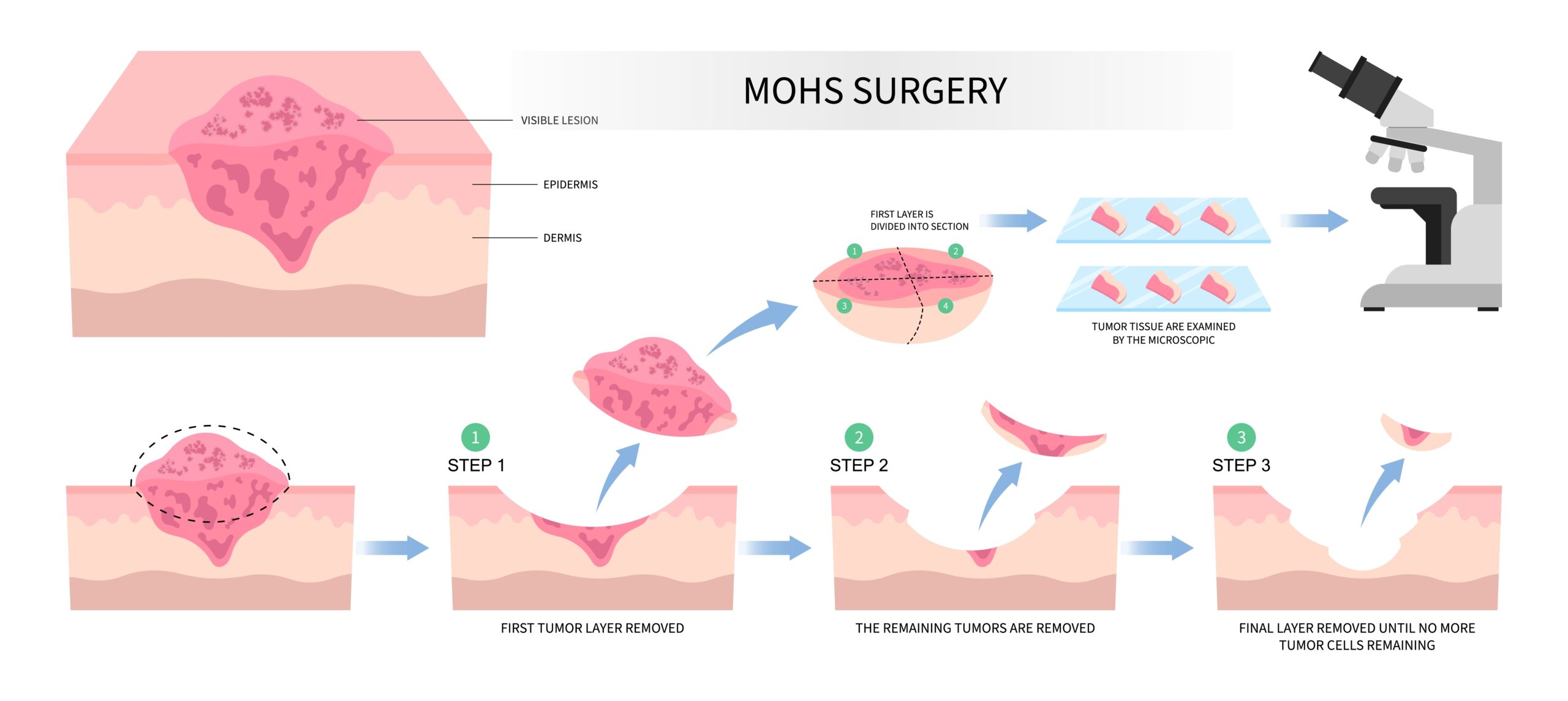 Mohs,Surgery,Basal,Cell,Microscopic,Reconstruction,Paget's,Disease,Inflammation,Biopsy