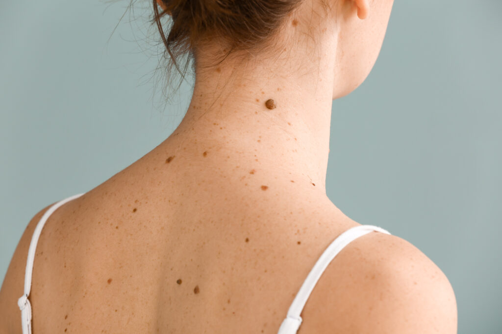 Young,Woman,With,Moles,On,Grey,Background