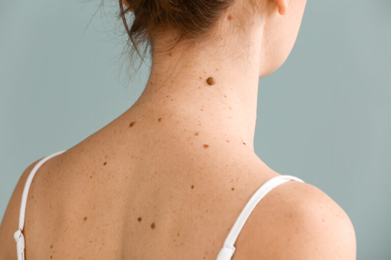 11 Signs It’s Time to Get Your Moles Checked Out by Your Dermatologist ...