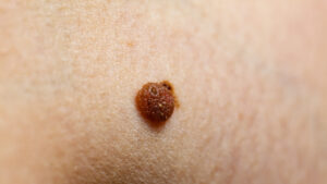 Skin,Disease.,Closeup,Brown,Mole,On,Caucasian,Human,Body.