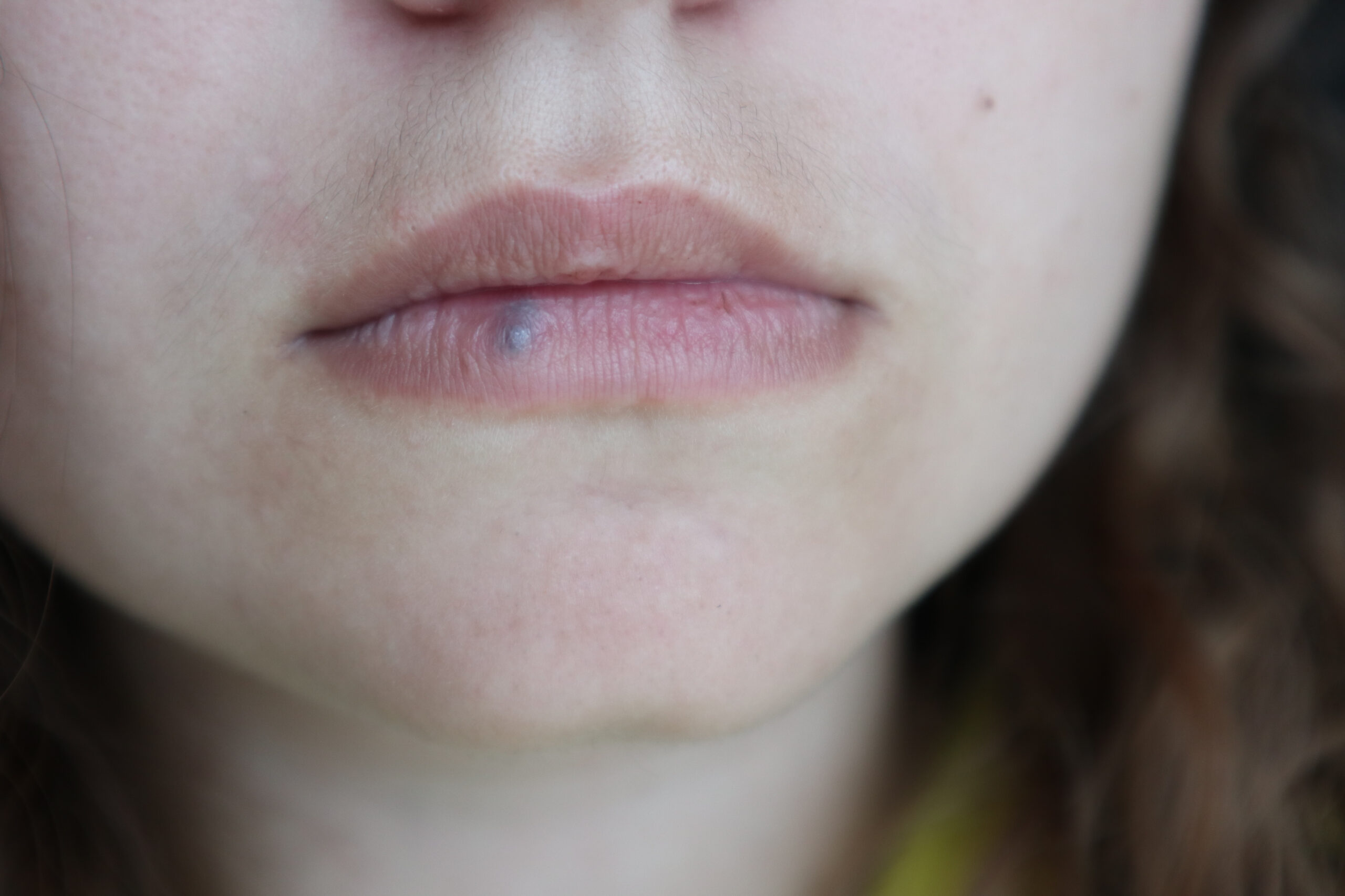 Lip,Hemangioma,Of,The,Woman,With,Mustache