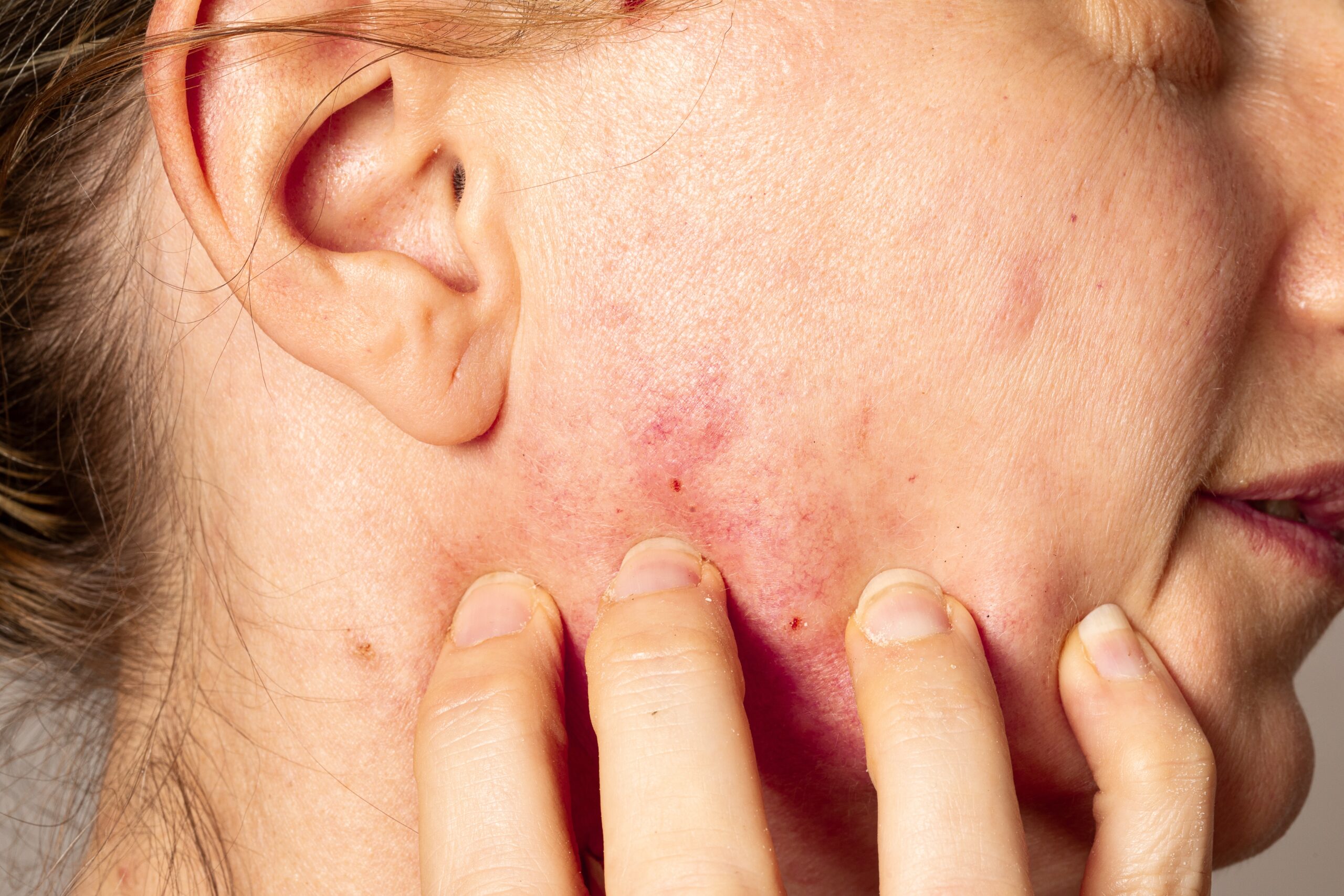 Close up,Of,A,Caucasian,Woman,Suffering,From,Rosacea,Touching,Her