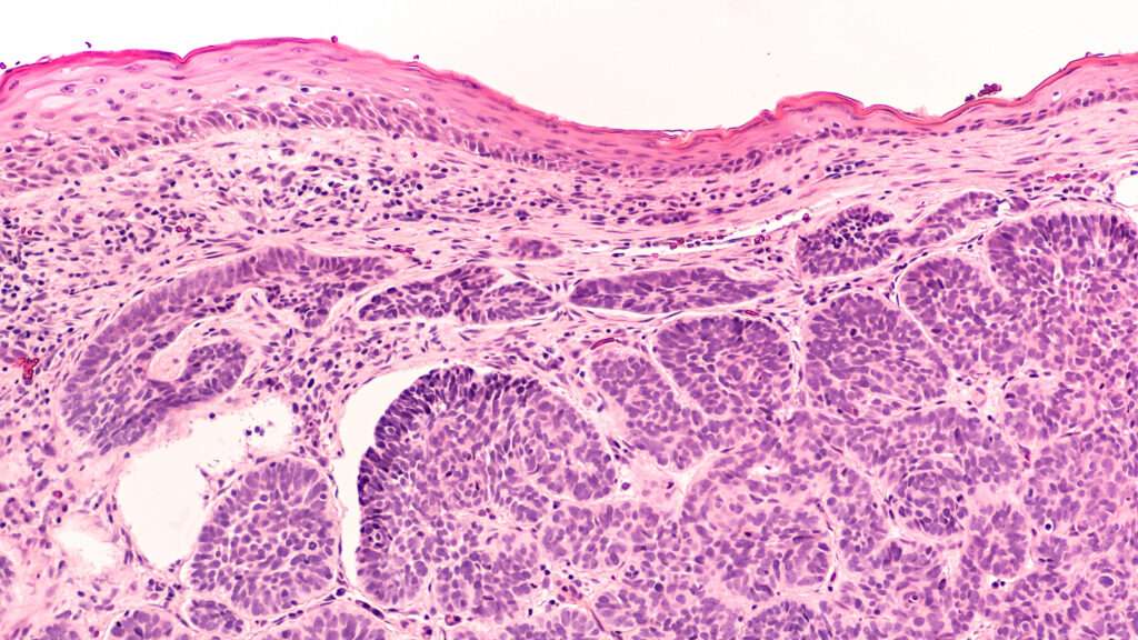 Skin,Biopsy,Pathology,Of,Basal,Cell,Carcinoma,,The,Most,Most