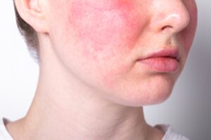 Rosacea,Couperose,Redness,Skin,,Red,Spots,On,Cheeks,,Young,Woman