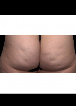QWO Cellulite Treatment Injections